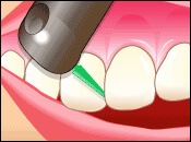 歯周病予防に欠かせないメンテナンス治療のご案内